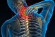 درمان دردهای شدید گردن با فیزیوتراپی